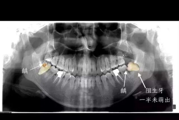 男子一次拔牙23颗后不幸离世 一次只能拔一颗吗？-第2张图片-海印网